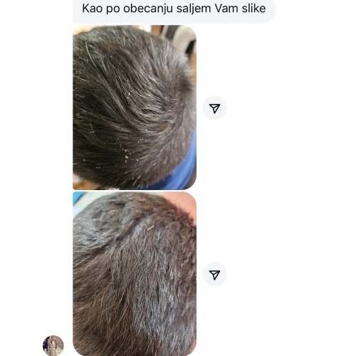 dandruf Å¡ampon